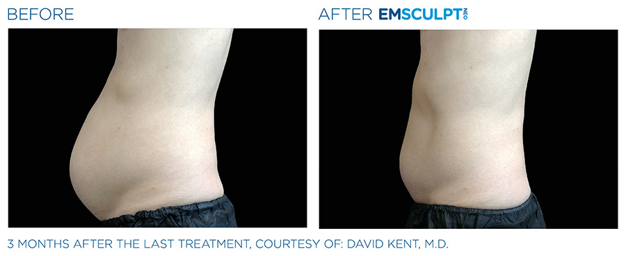 Before and After Photo | EMSCULPT NEO | Body Sculpting