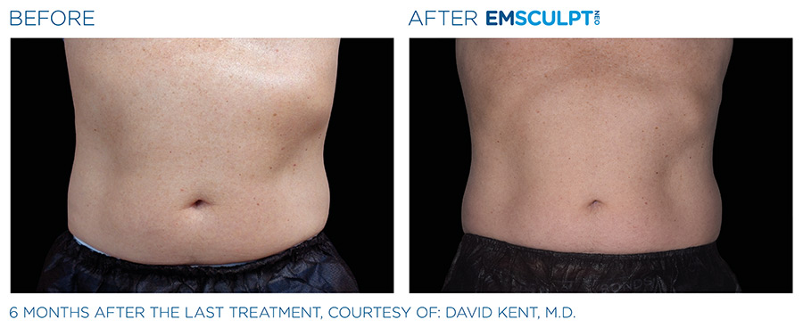 Before and After Photo | EMSCULPT NEO | Body Sculpting