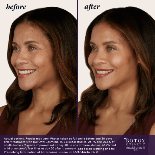 Before and After Photo | BOTOX